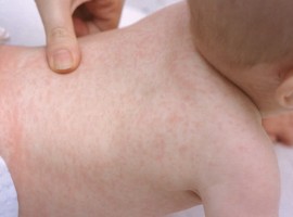 Khuyến cáo quản lý và điều trị sởi